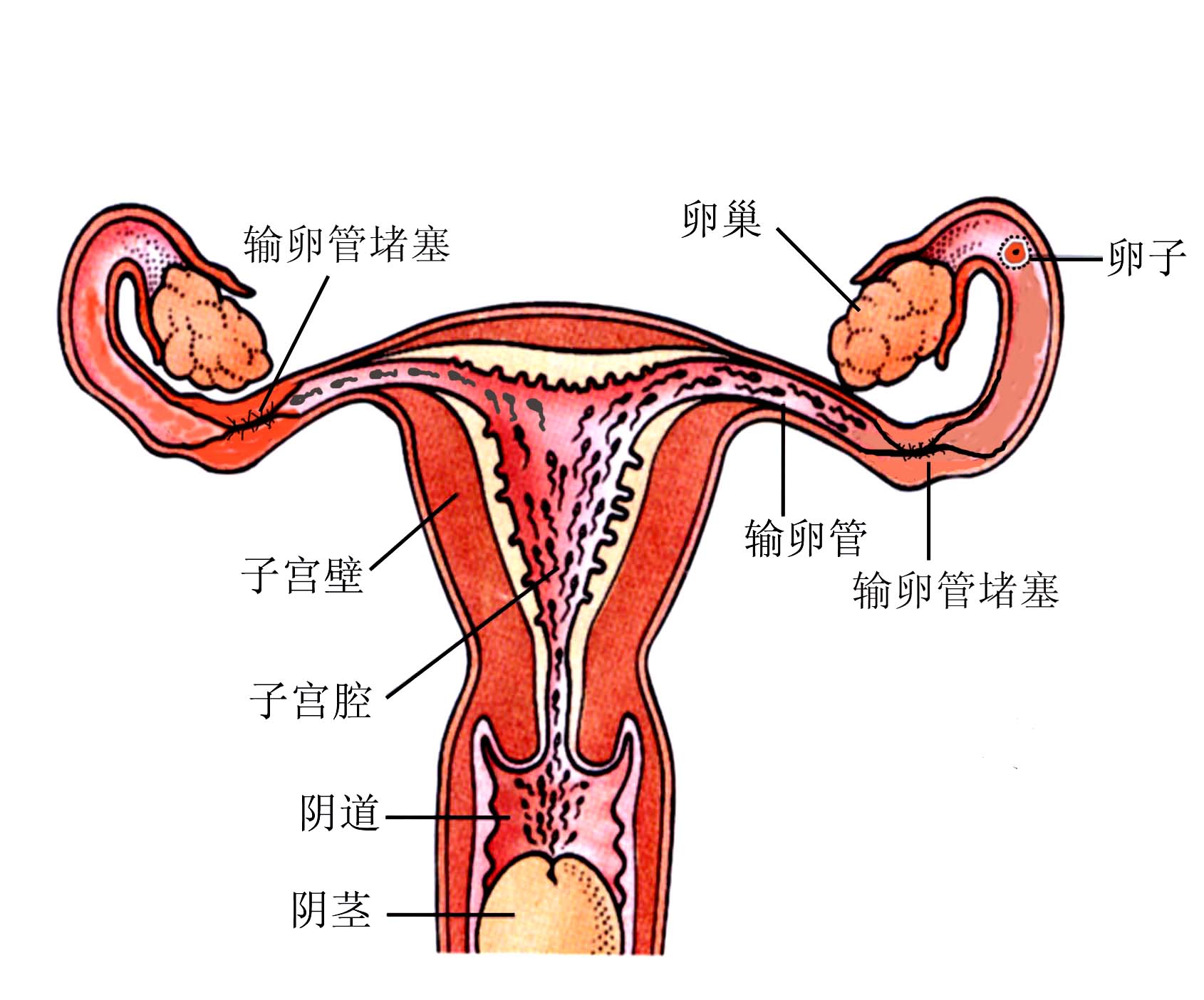 輸卵管有積液會(huì)影響懷孕嗎