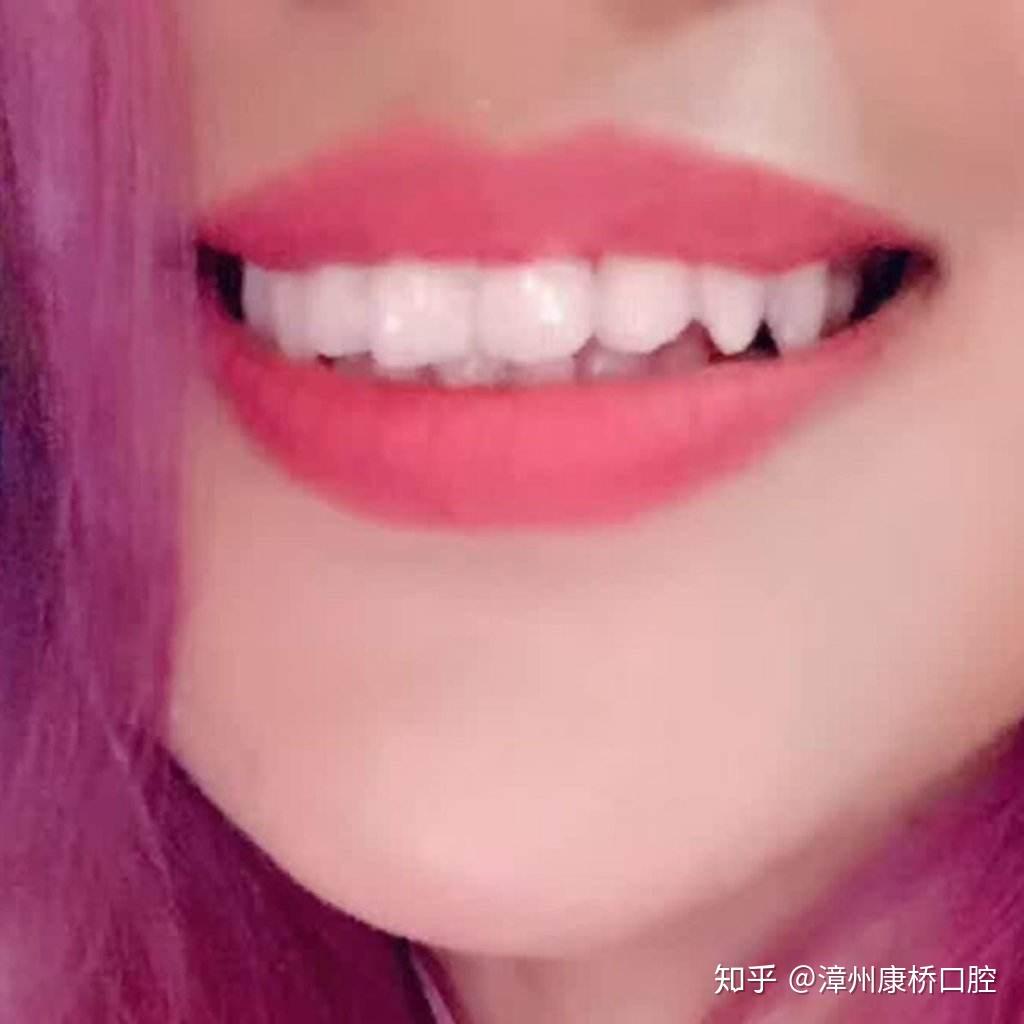 牙齒美白樹脂