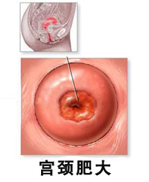 宮頸肥大糜爛怎么治療,宮頸肥大糜爛的治療方法及其解讀說明,戰(zhàn)略性方案優(yōu)化_Chromebook56.71.50