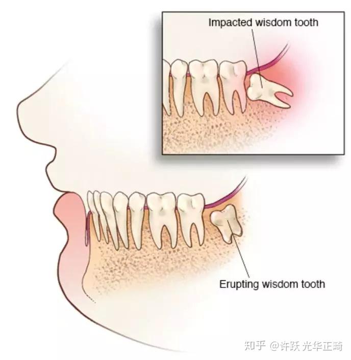 牙髓炎怎么止疼最快,牙髓炎疼痛迅速緩解指南——了解止疼方法，迅速處理解答問題,可靠性策略解析_儲蓄版78.91.78