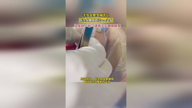 女嬰兩天哭鬧不止竟因頭發(fā)絲繞腳趾