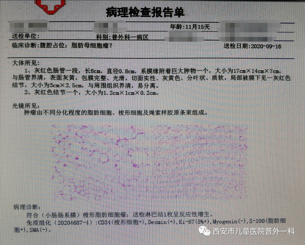 女子腫瘤復(fù)發(fā)三次腹部積液近百斤迅速執(zhí)行計劃設(shè)計_凹版56.80.65